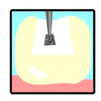 Crown preparation