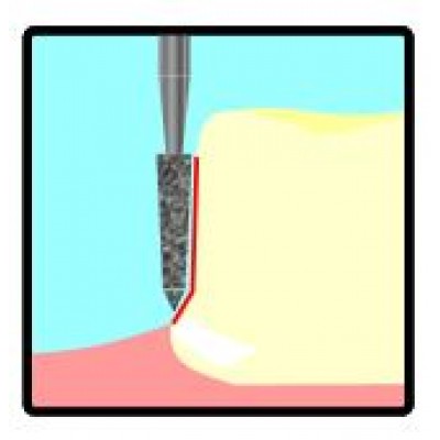 Crown Preparation