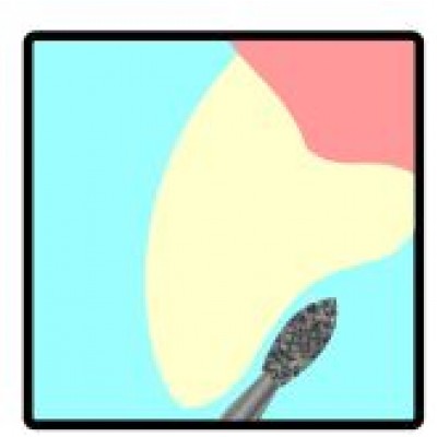 Occlusal/Lingual Reduction